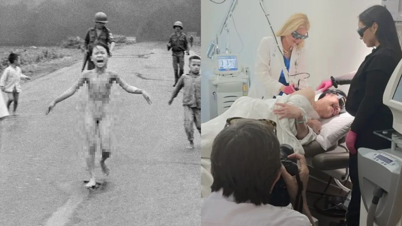 'Napalm Girl' in Vietnam war photo gets final burn treatment 50 years later