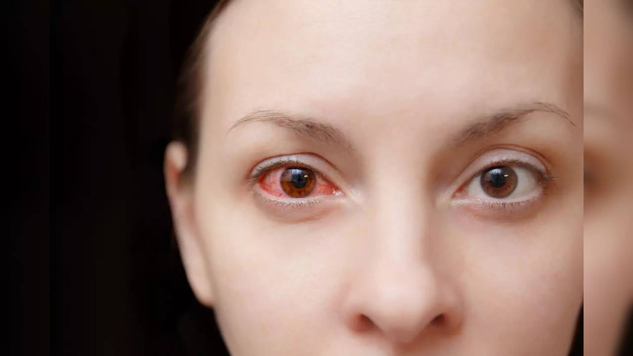 Eye redness? This could be Iritis, know the causes and risks of the ...