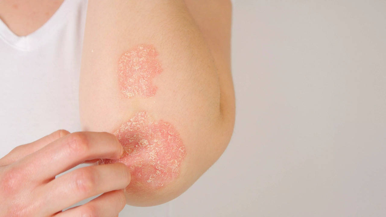 When it comes to psoriasis management, diet has a huge role to play and as does Ayurveda.