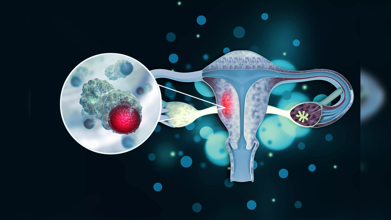 Cervical cancer is when abnormal cells grow at an uncontrolled pace in the cervix or around it to form a tumour.