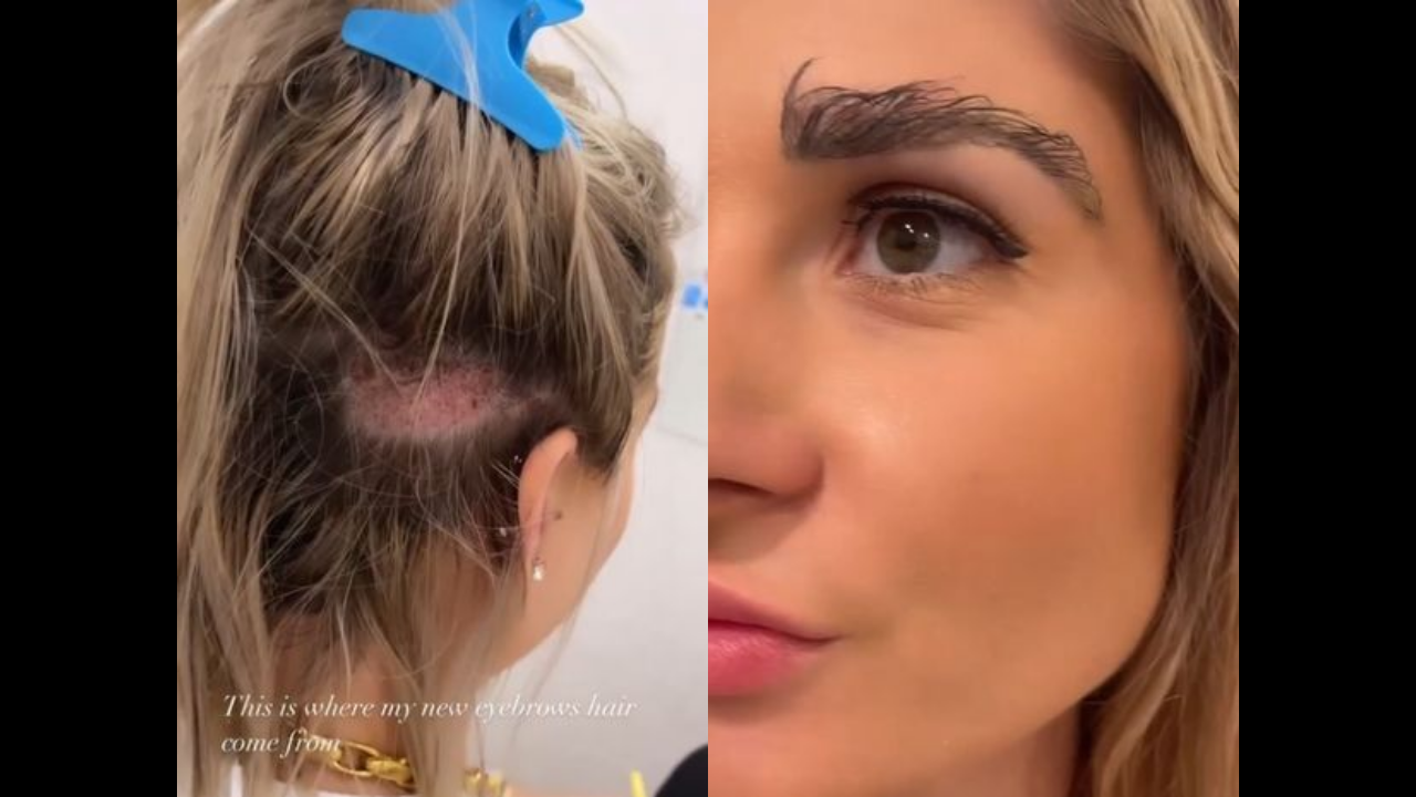 Woman gets eyebrow transplant using hair from head - but now has to keep cutting them as they won't stop growing