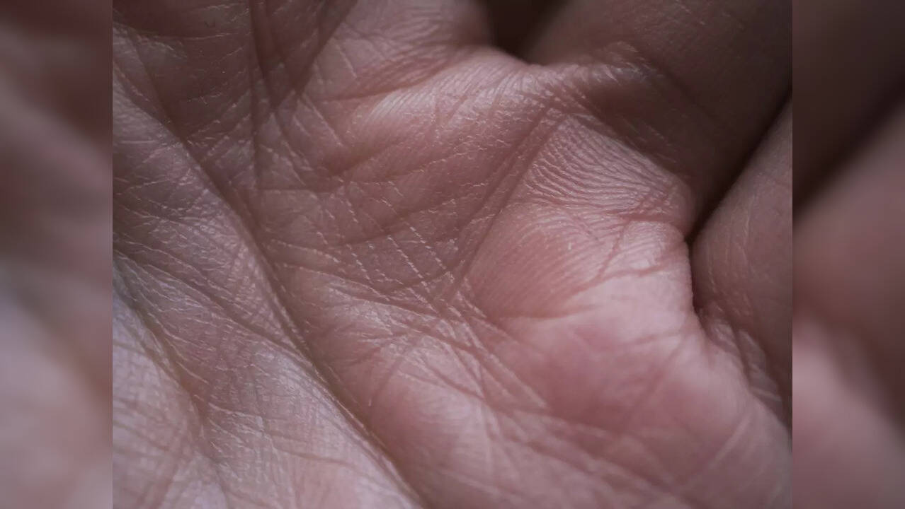 Why do my palms always feel sweaty? Health News, Times Now