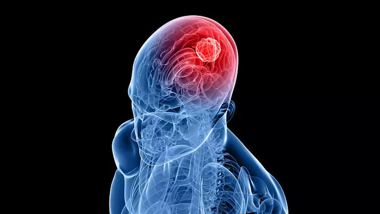 istockphoto-brain tumour