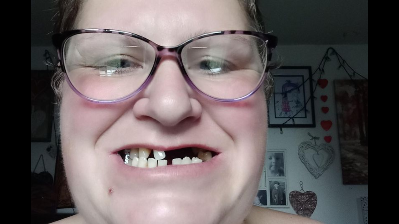 Woman forced to pull out 13 of her own teeth because she couldn't find dentist