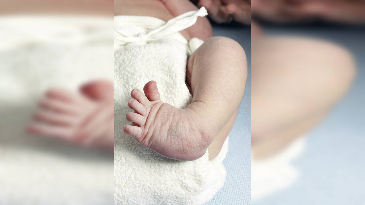 All you should know about Clubfoot, the leg deformity in babies, and
