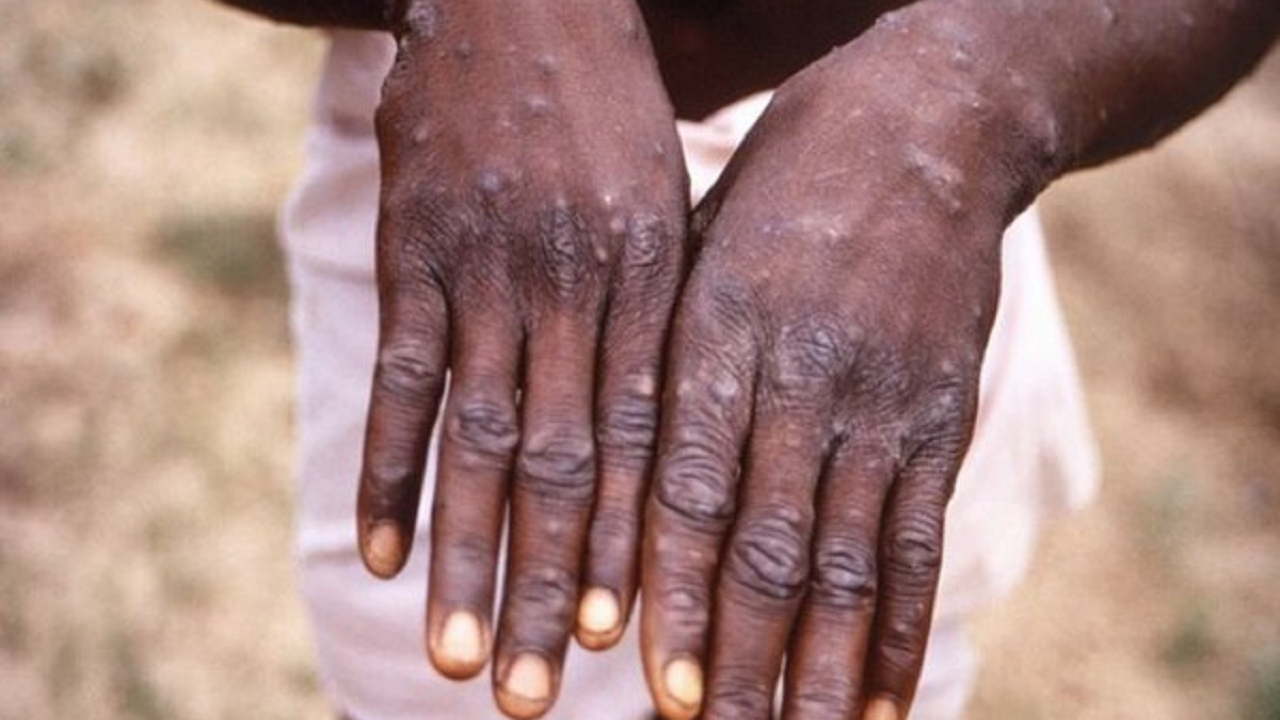 ​Monkeypox | Representational image