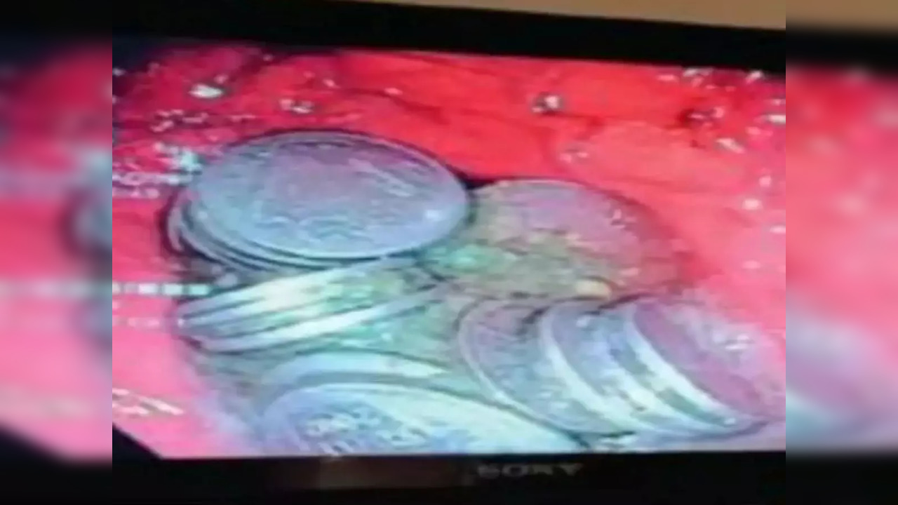 An endoscopic view of the metallic lump of 63 coins in the man's stomach removed by doctors