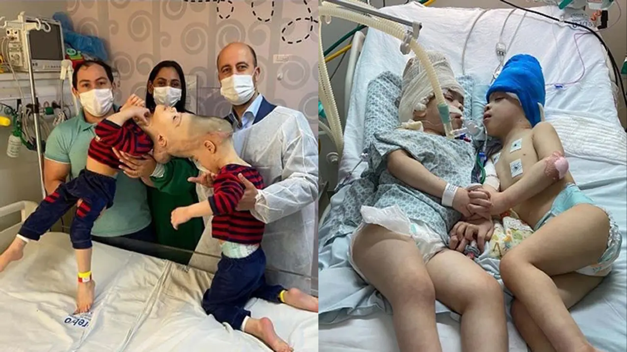 Conjoined twins whose brains were fused together separated by UK surgeon