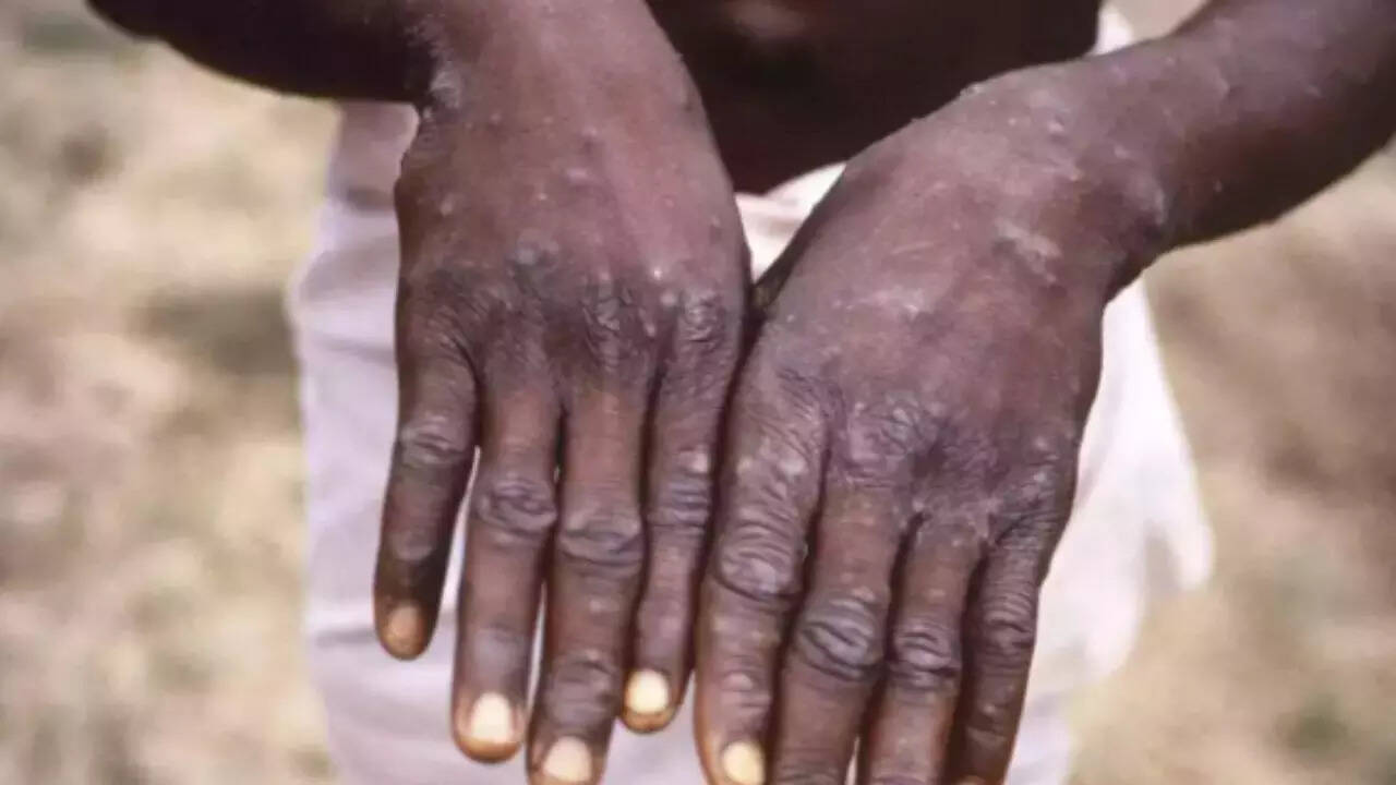 Three Monkeypox cases in Delhi