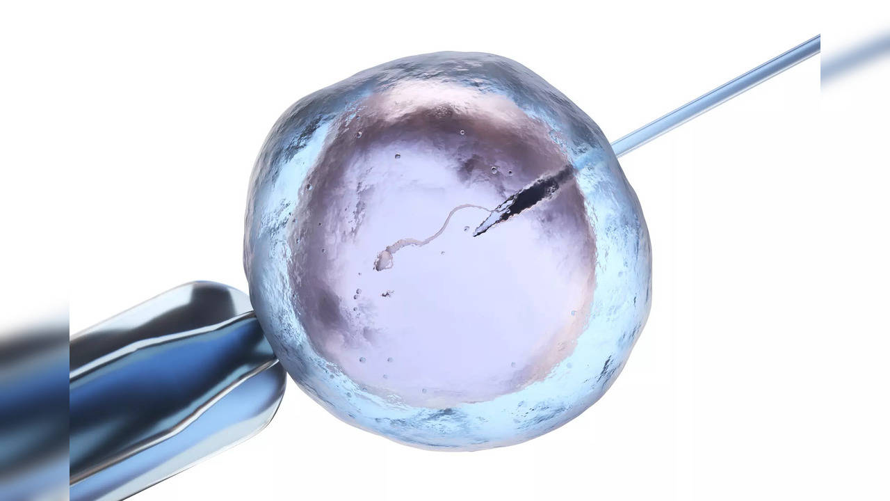 IVF is a procedure which involves fertilising mature eggs from the ovaries with sperm outside the body in a lab to form an embryo and then clinically place it in the uterus.