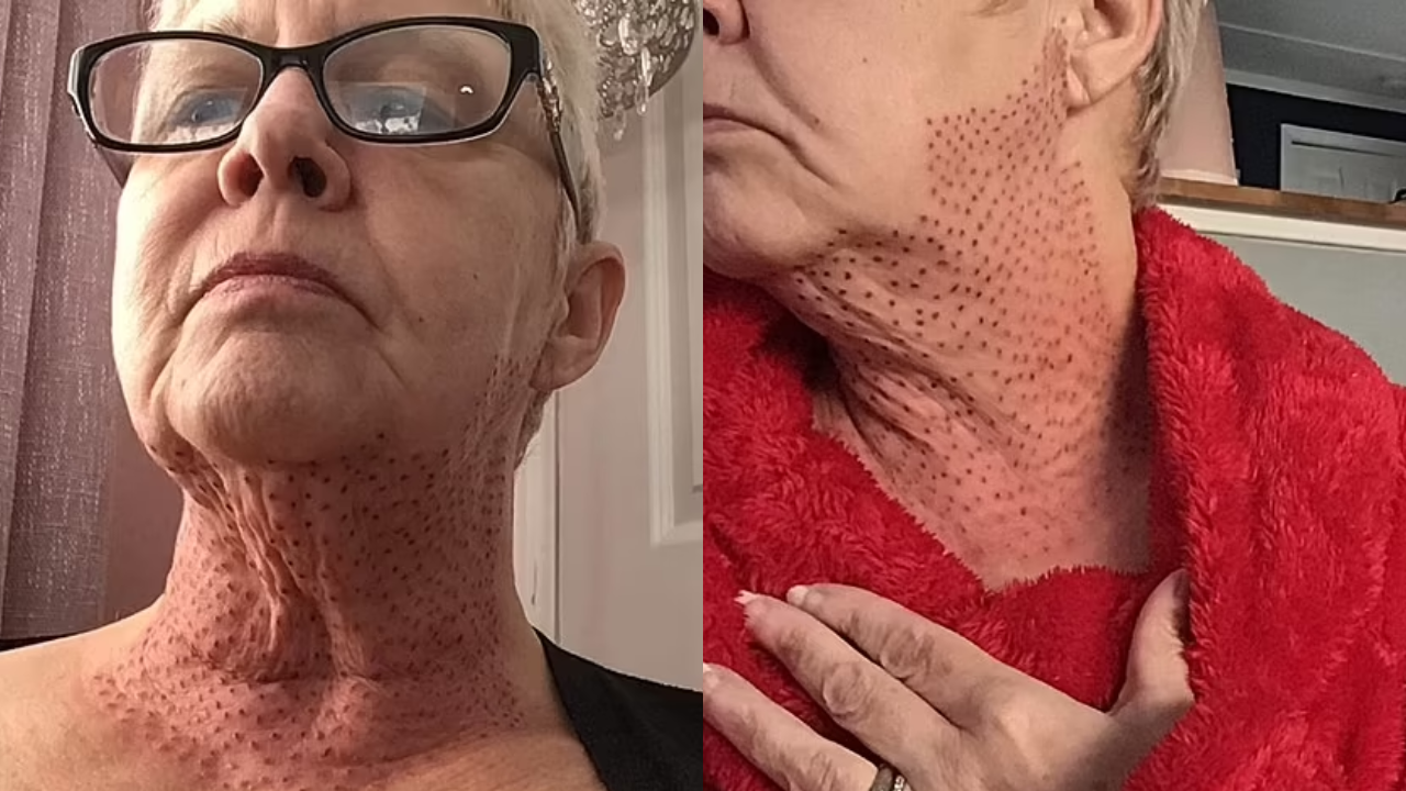 Woman left with 'lizard neck' after botched procedure to fix her double chin