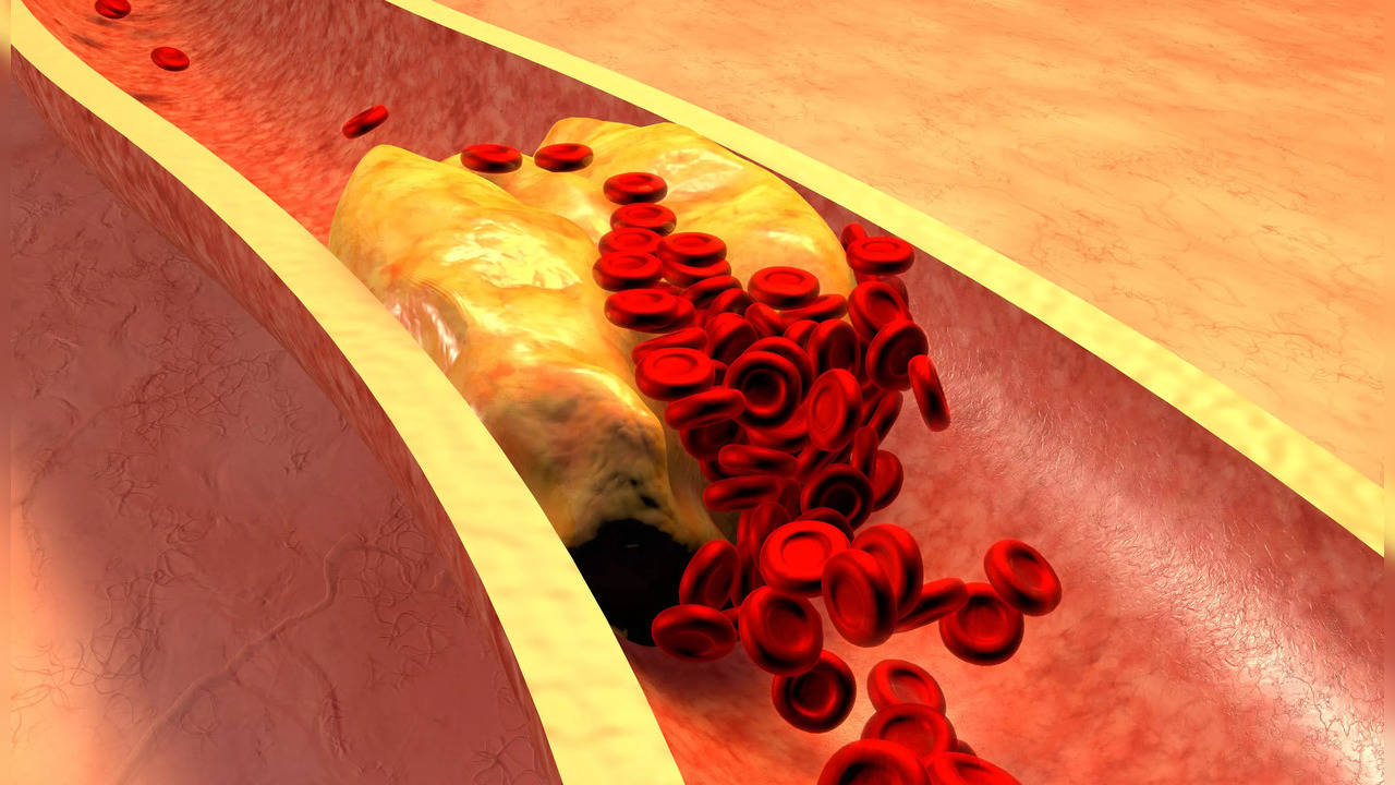 People with higher levels of harmful fats or cholesterol commonly linked to heart diseases are more likely to experience ongoing symptoms from both Covid-19 and non-Covid disease, according to a study not peer-reviewed yet.