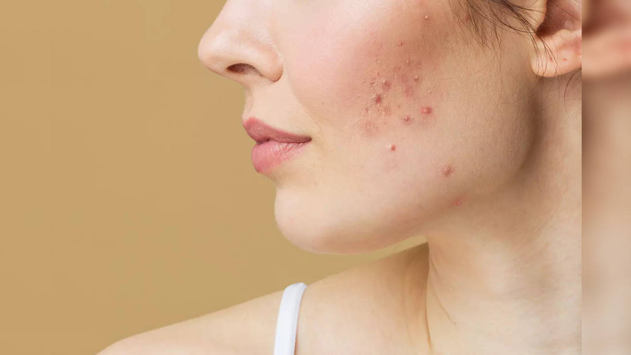 Adult acne: Are you still having pimples in your 30s and 40s? Here's how to  get rid of them