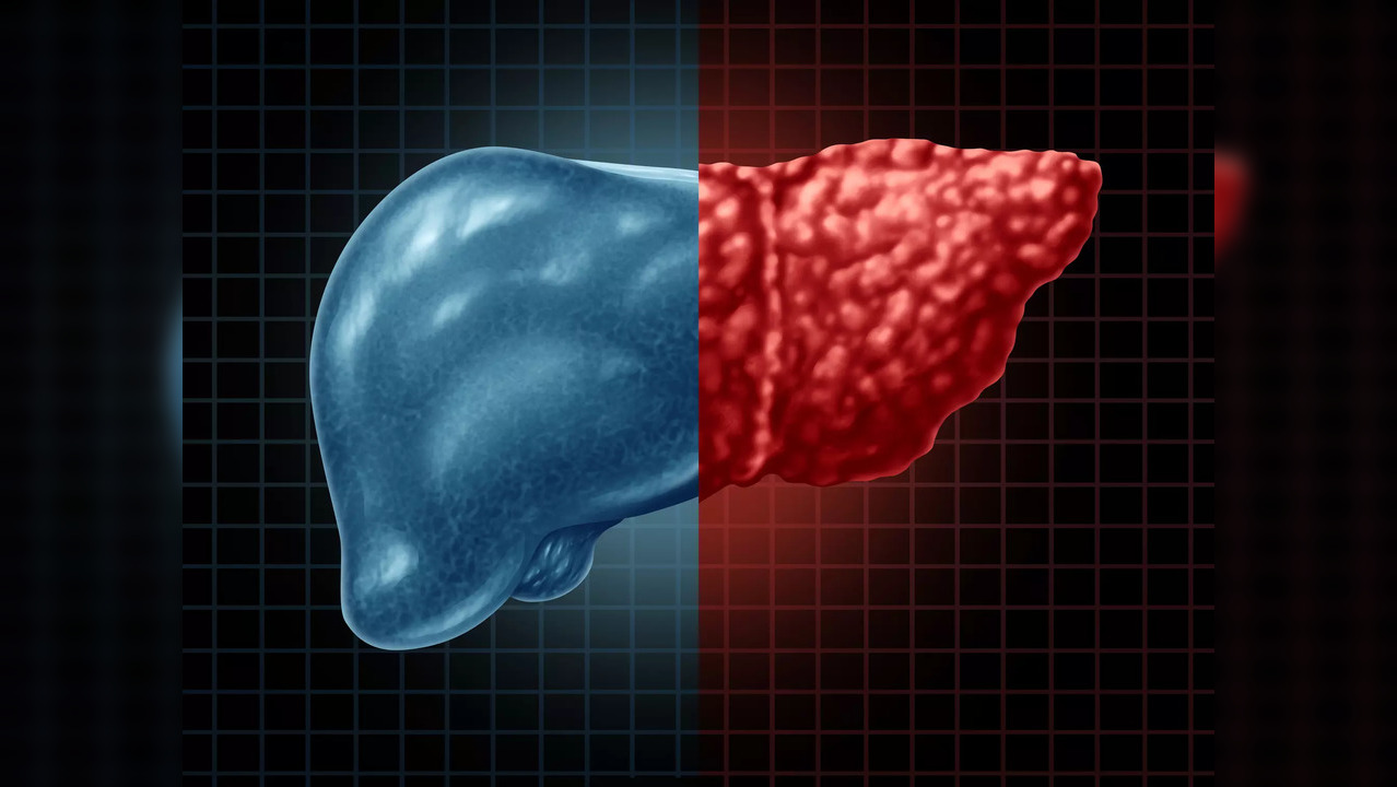 NAFLD refers to the build-up of fats in the liver which is unrelated to alcohol use.