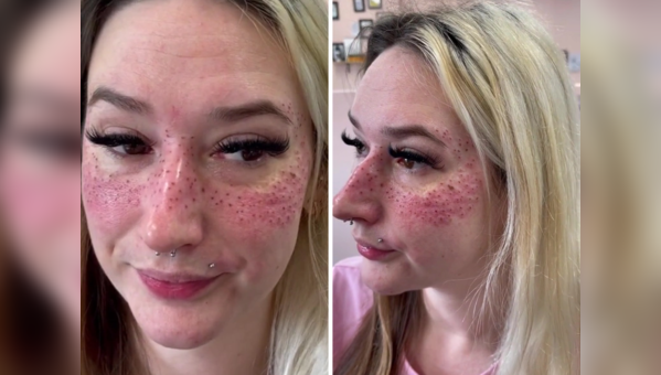 Bizarre: Woman travels 1,400 km to get tattoo of 'freckles' on her face ...