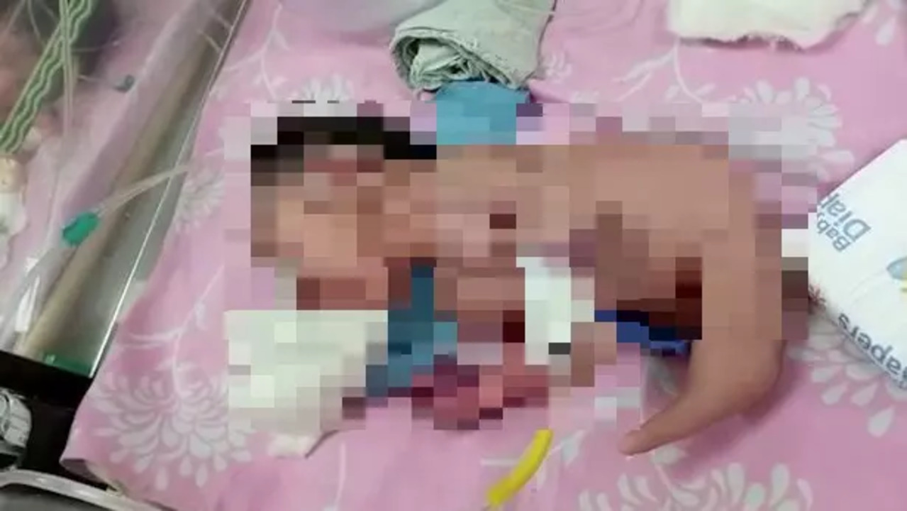 Baby born with horn-like structure instead of legs in Madhya Pradesh