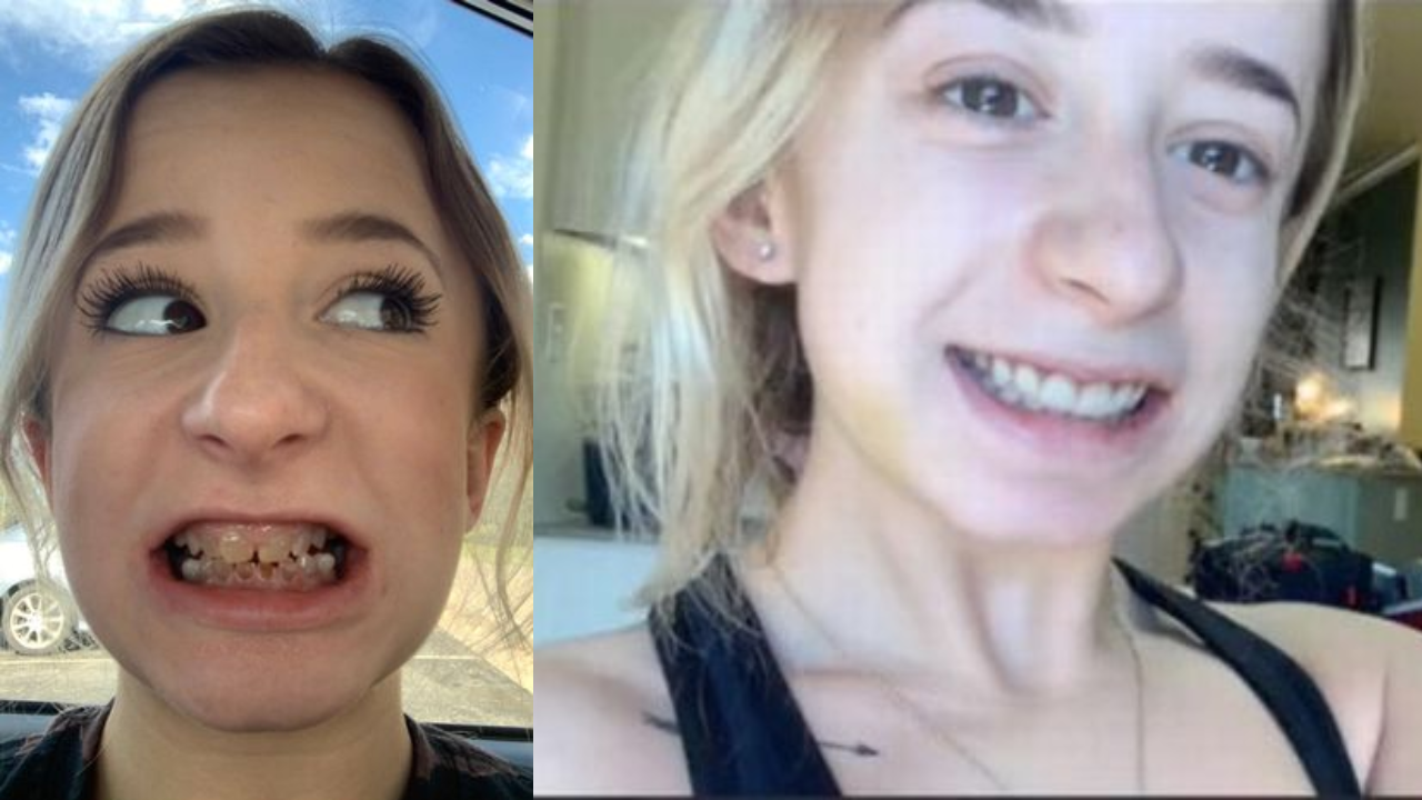 Woman born with transparent teeth gets life-changing dental surgery