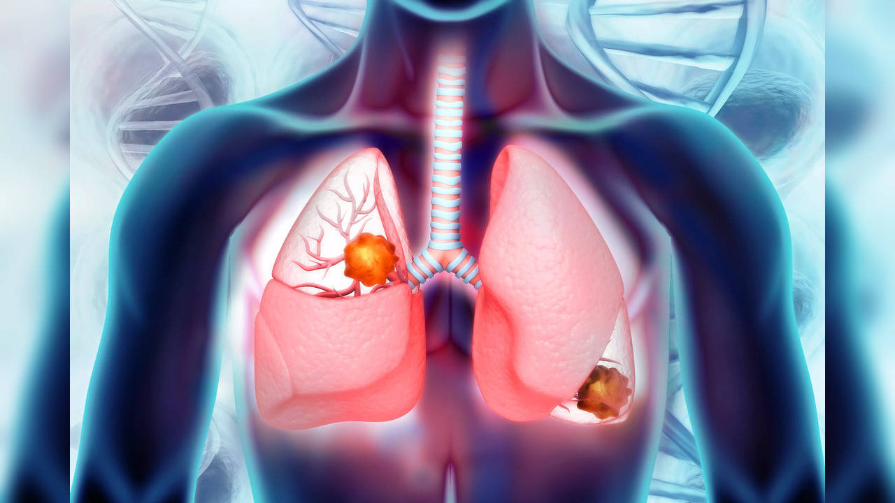 The medication is designed to target a mutated form of a gene known as KRAS that occurs in about 13% of non-small cell lung cancers, the most common form of the disease, and less frequently in some other solid tumors.