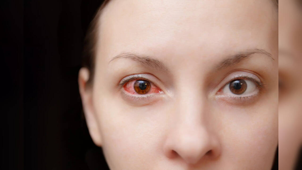 Red eyes 5 causes of sore eyes you need to know Health News, Times Now