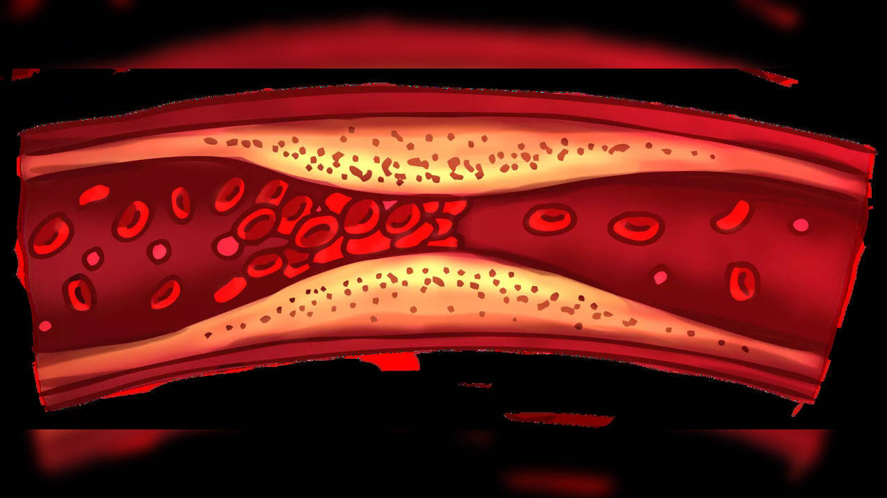 Deep Vein Thrombosis leads to a Blood Clot blamed on Grapefruit intake that messed up medication