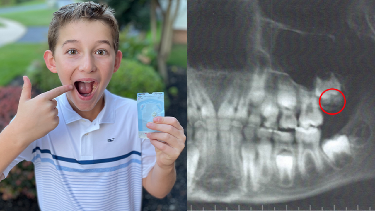 9-year-old becomes the youngest to ever have a wisdom tooth removed