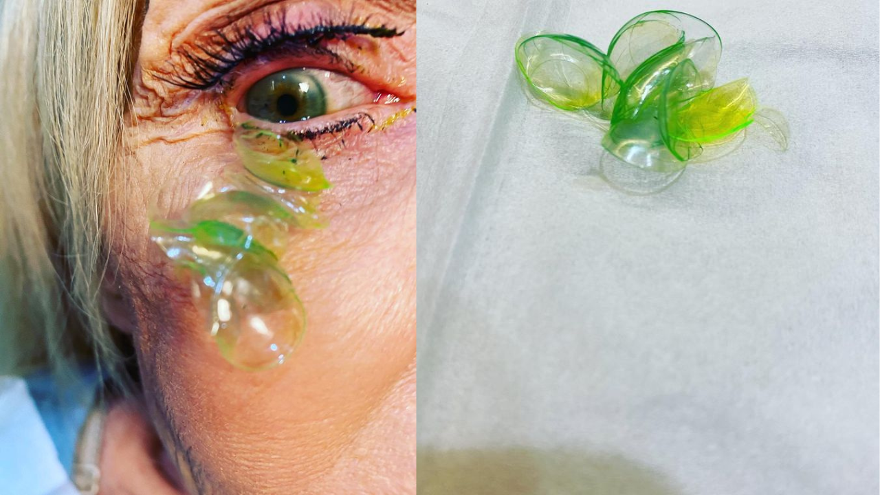 Doctor removes 23 contact lenses from patient's eye who slept with them every night