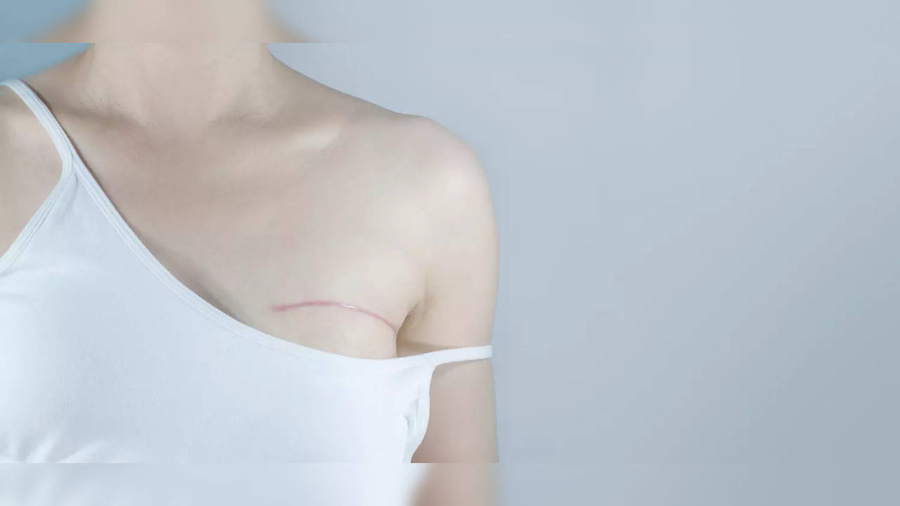 Mastectomy Vs Lumpectomy What Is The Difference