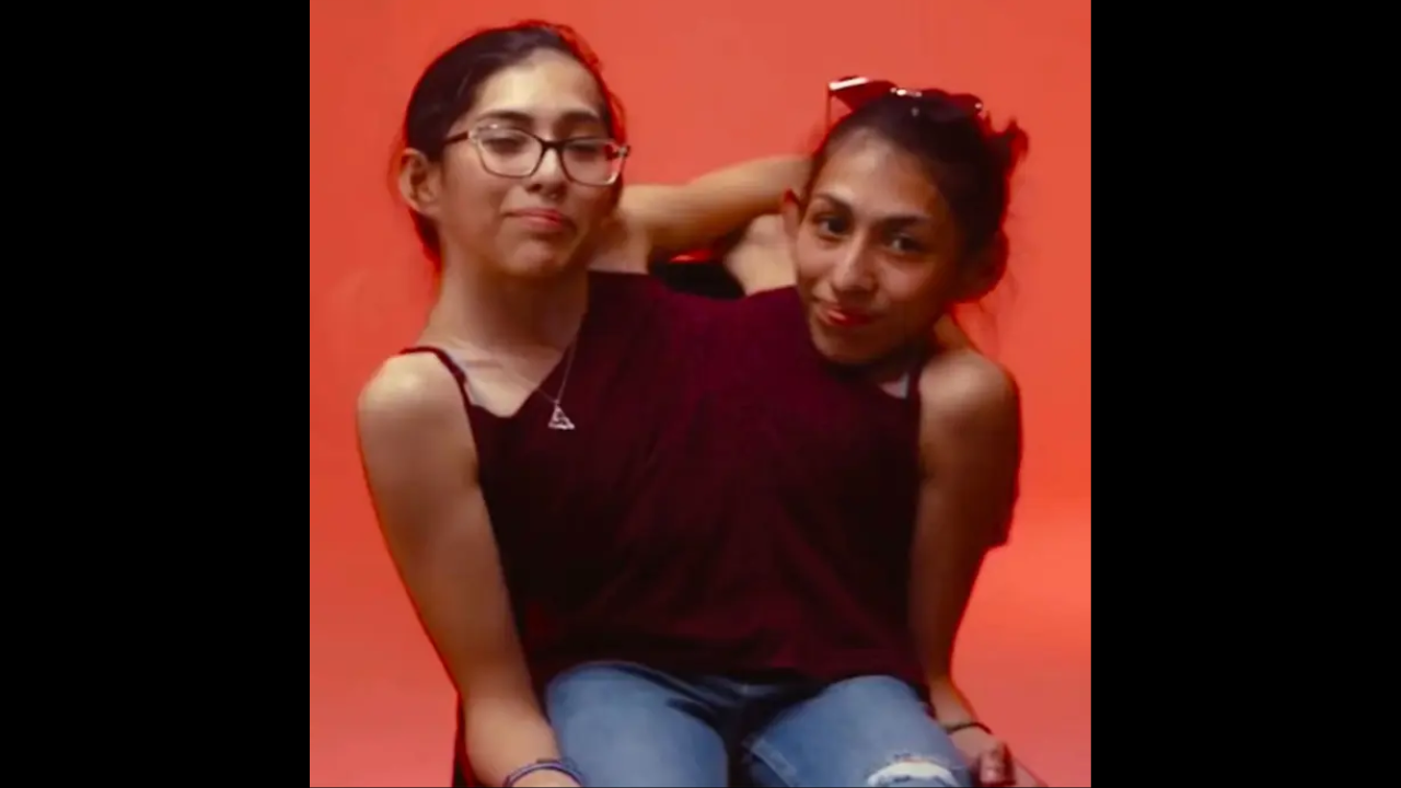 Conjoined twins Lupita and Carmen