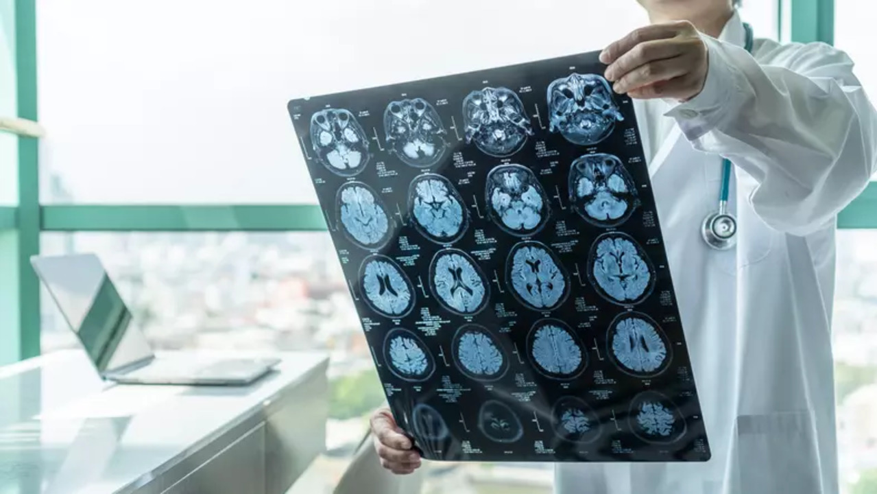 The World Health Organisation predicts that by 2050, 139 million people globally are expected to live with some form of dementia – and Alzheimer’s disease is likely to contribute to 60-70 per cent caseload.