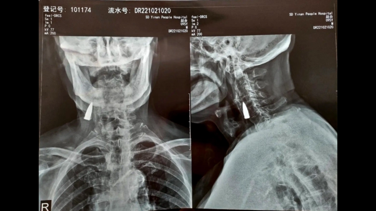 X-ray reveals bullet lodged in war hero's neck for 77 years