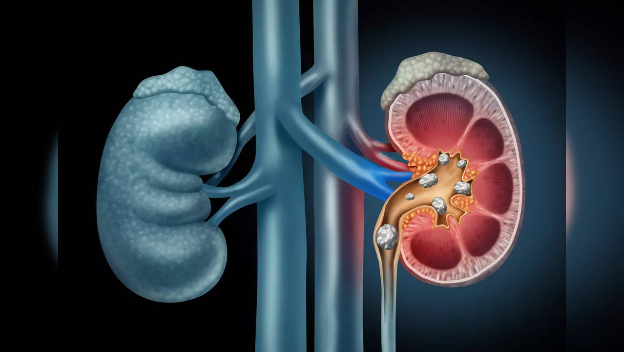 kidneystones