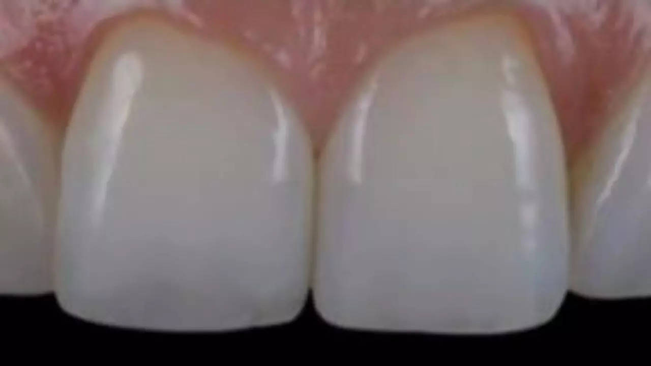 Triangular-shaped teeth