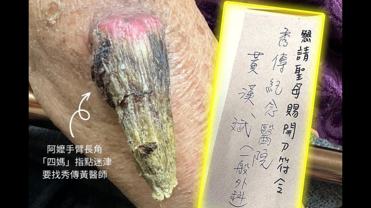 ​Grandmother has ultra-rare 'fairy' horn growing on her arm​