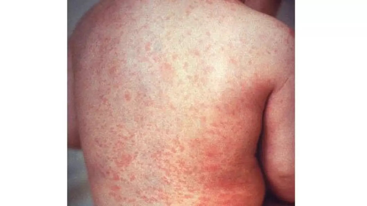 Measles