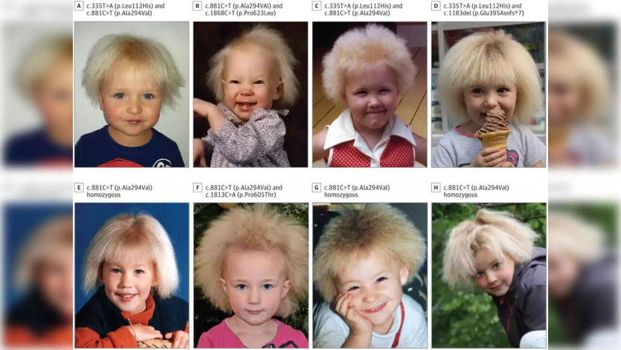 What is hair syndrome or Spun glass hair? This Australian