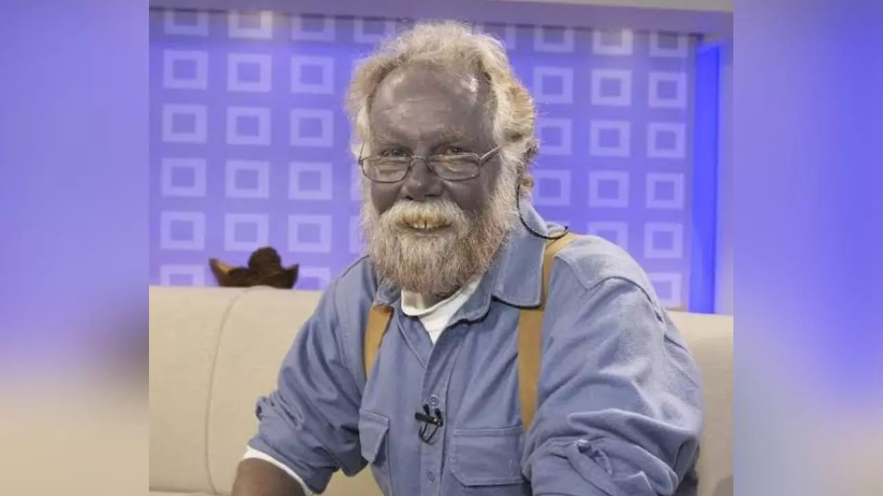 Man called 'Papa Smurf' after skin turned blue | Viral News, Times Now