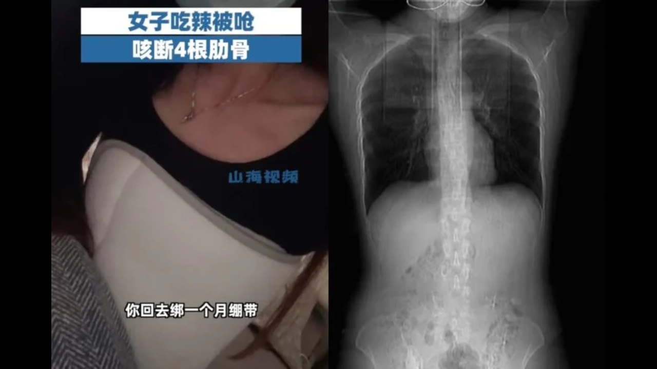 Woman fractures 4 ribs while coughing after eating spicy food