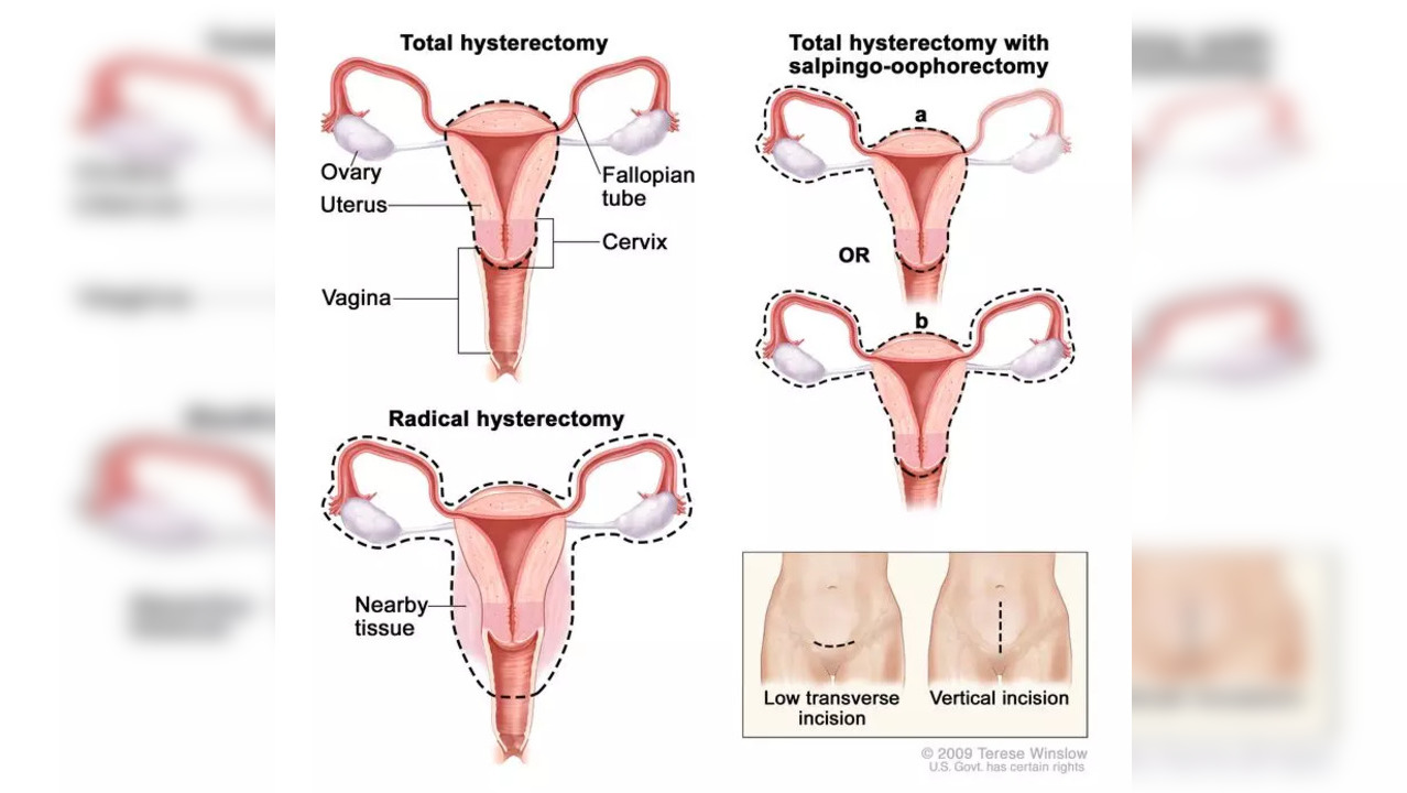 Cervical Cancer