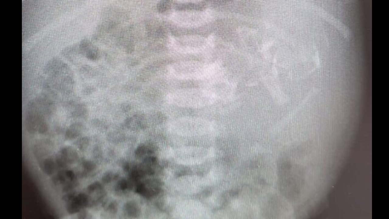 Baby born with 'twin' inside her stomach in extremely rare condition