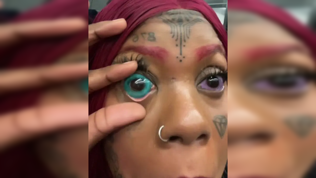 Woman Going Blind After Getting Her Eyeballs Tattooed Blue And Purple 