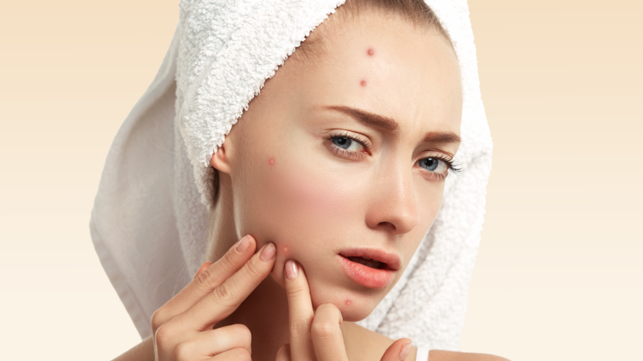 5 easy ways to get rid of pimples fast. Pic Credit: Freepik