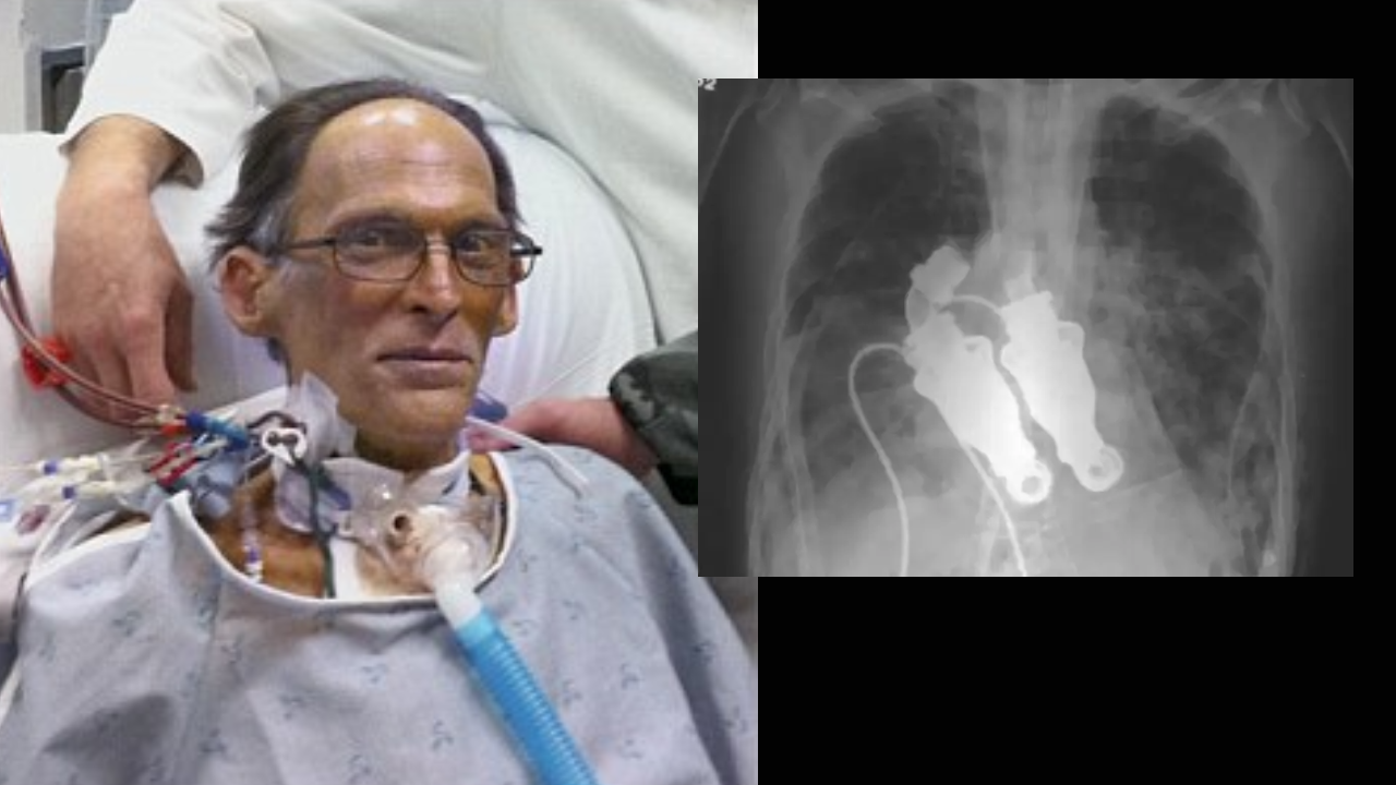 World's first heartless human was able to live without a pulse