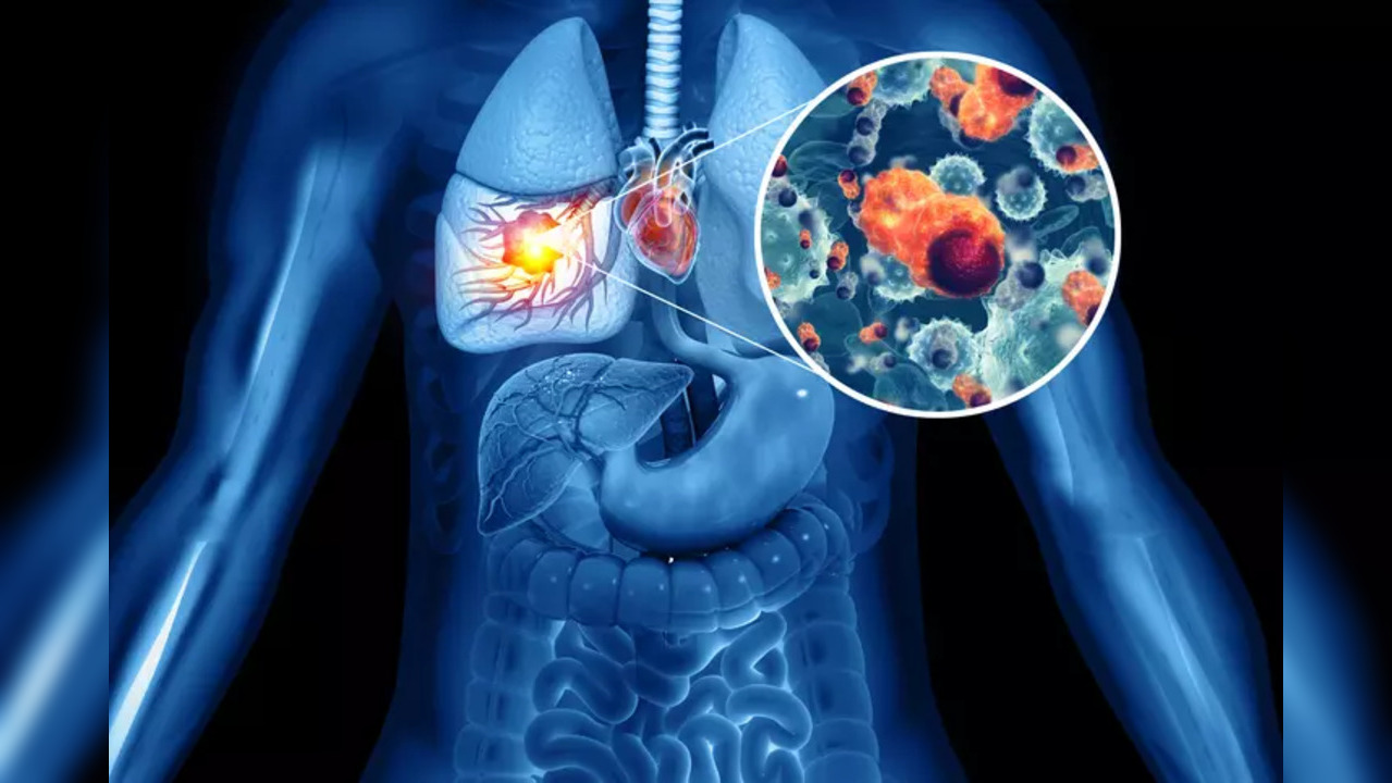 The team created Sybil, a deep-learning model that analyses scans and predicts lung cancer risk for the next one to six years, using data from the National Lung Screening Trial (NLST) in the US, the study said.