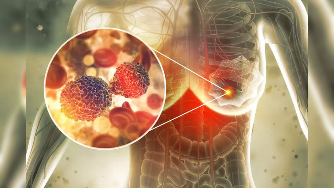 Breast Cancer Doctor demonstrates simple massages every woman should