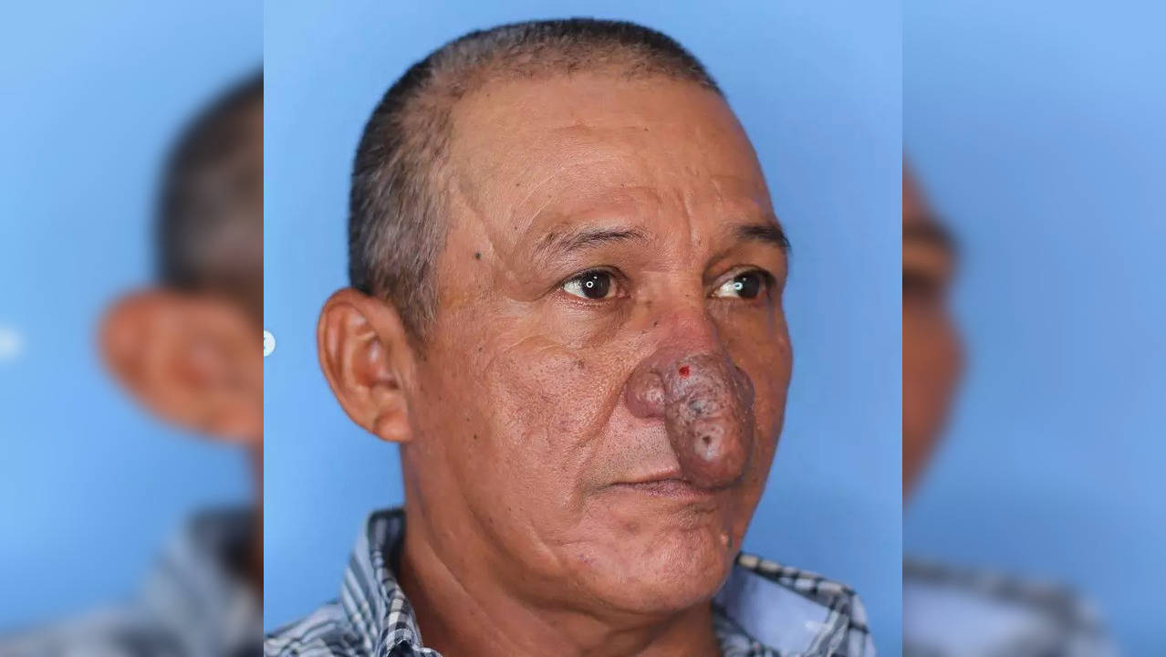 52-year-old Conrado Estrada had an elongated, dimpled nose that resembled the penis almost completely. (Photo credit: Dr. Thomas Romo/Instagram)