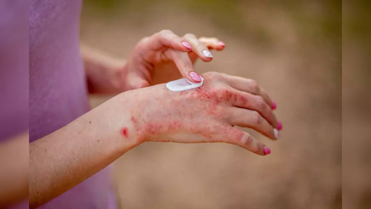 can-psoriasis-medicines-give-you-skin-cancer-study-blames-an