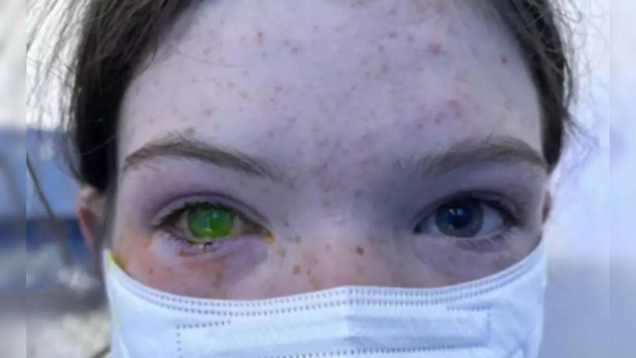 In a case reported in a 13-year-old who had already been suffering from eye issues, contracted the infection after the insect entered her eye during a camping trip. (Photo credit: 7news)