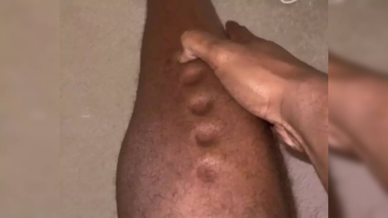 The Olympian went on to point at his scars where he smashed his legs weeks ago and experienced oedema – build-up of fluid which causes tissues to become swollen due to standing or sitting in the same place for too long. (Photo credit: TikTok)