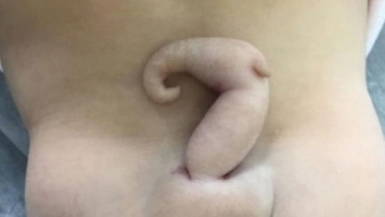 Baby girl born with rare 6 cm tail protruding from back