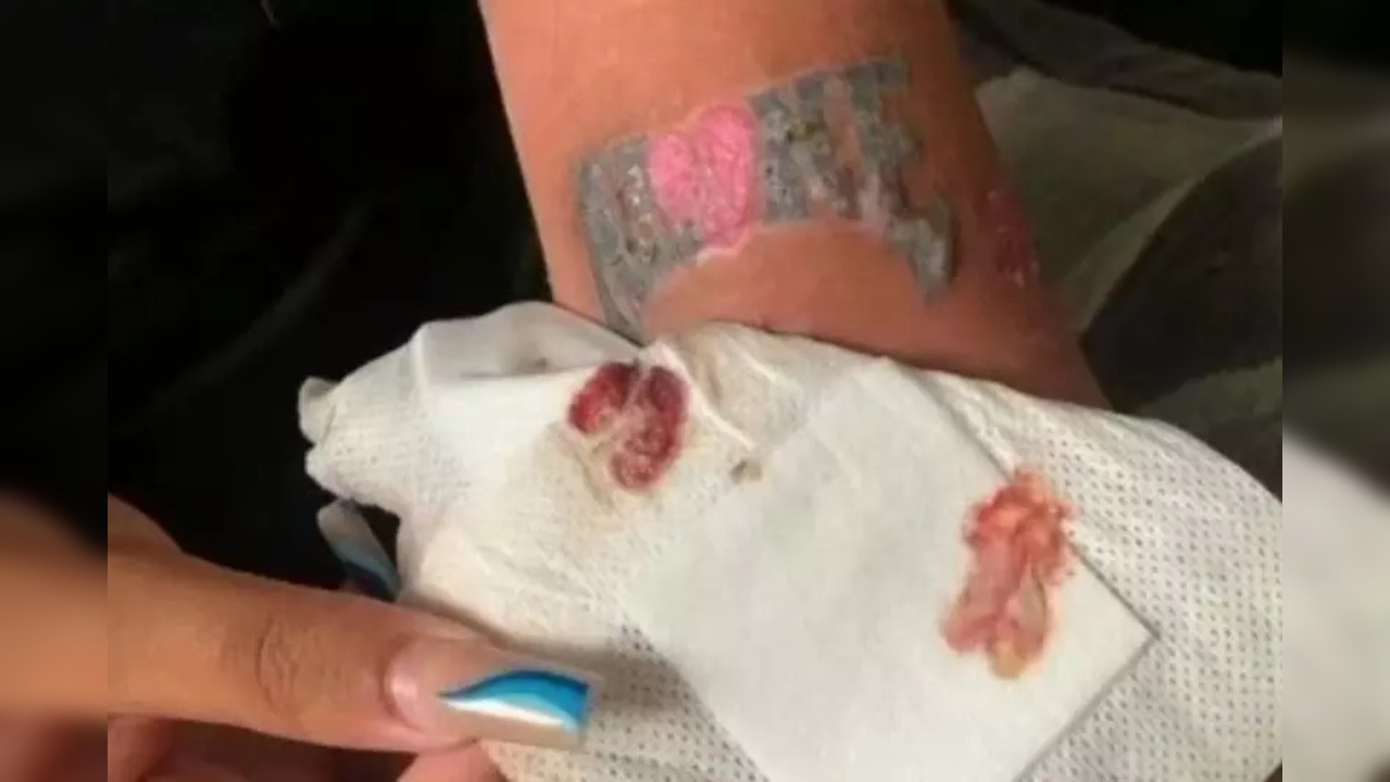 Suraya Khan was then put on a two-week antibiotics course – she had the tattoo redone six months later as the area became patchy when the infection scarred her arm. (Photo credit: Suraya Khan/Tiktok)